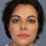 Facelift Before & After Patient #11914