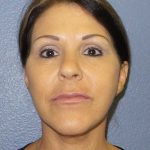 Facelift Before & After Patient #11853