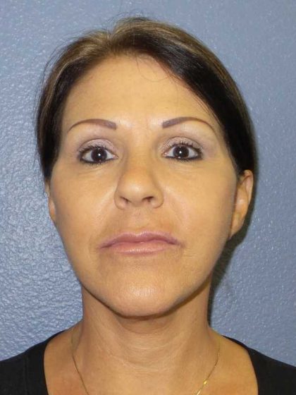 Facelift Before & After Patient #11853