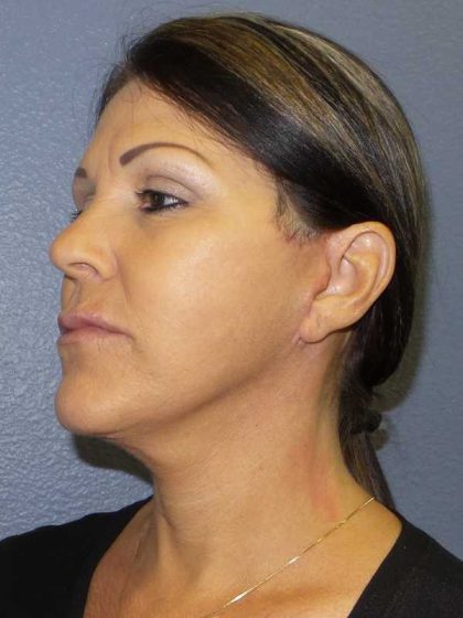 Facelift Before & After Patient #11853