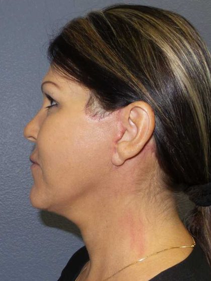 Facelift Before & After Patient #11853