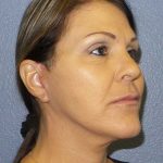 Facelift Before & After Patient #11853