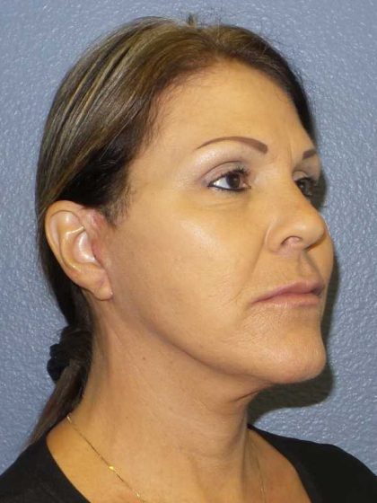 Facelift Before & After Patient #11853