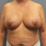 Breast Lift with Implant (Augmentation Mastopexy) Before & After Patient #11206
