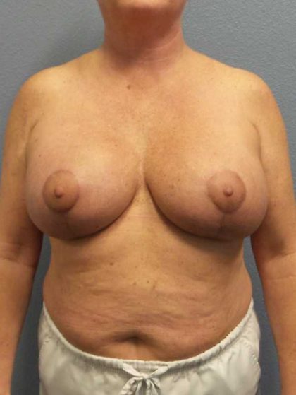 Breast Lift with Implant (Augmentation Mastopexy) Before & After Patient #11206
