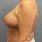 Breast Lift with Implant (Augmentation Mastopexy) Before & After Patient #11206