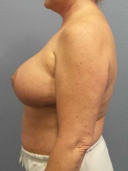 Breast Lift with Implant (Augmentation Mastopexy) Before & After Patient #11206