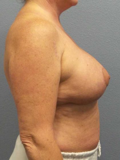 Breast Lift with Implant (Augmentation Mastopexy) Before & After Patient #11206