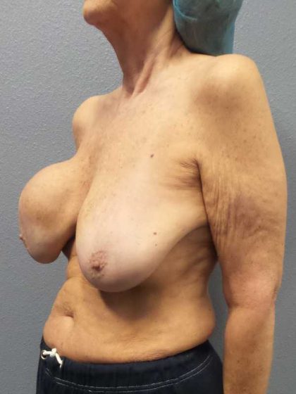 Augmentation Mastopexy Revision Before & After Patient #11269