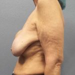 Augmentation Mastopexy Revision Before & After Patient #11269