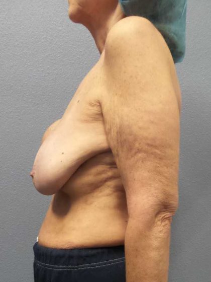 Augmentation Mastopexy Revision Before & After Patient #11269
