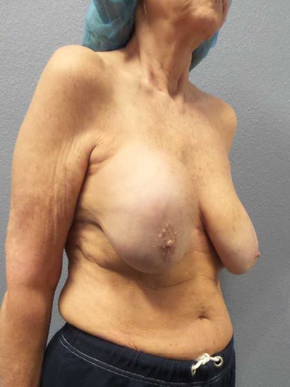 Augmentation Mastopexy Revision Before & After Patient #11269