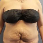 Abdominoplasty Revision Before & After Patient #11142