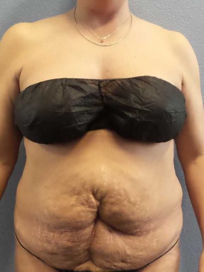 Abdominoplasty Revision Before & After Patient #11142