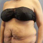 Abdominoplasty Revision Before & After Patient #11142