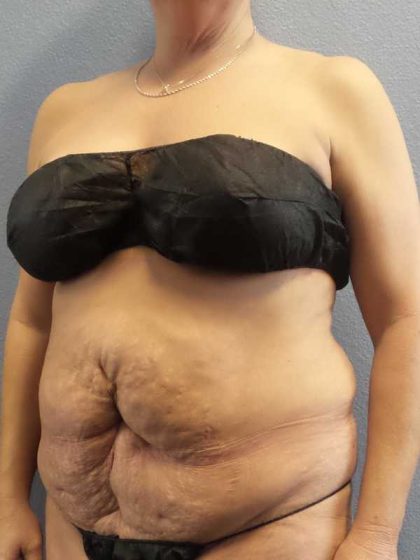 Abdominoplasty Revision Before & After Patient #11142