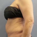 Abdominoplasty Revision Before & After Patient #11142