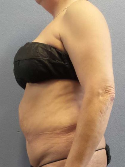 Abdominoplasty Revision Before & After Patient #11142