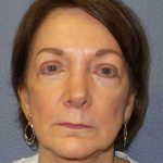 Facelift Before & After Patient #11705