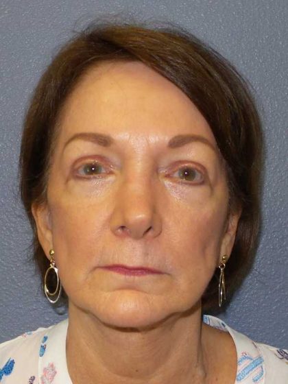 Facelift Before & After Patient #11705