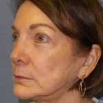 Facelift Before & After Patient #11705