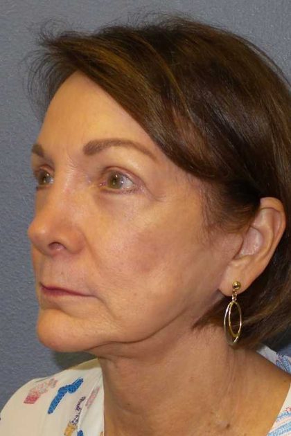 Facelift Before & After Patient #11705
