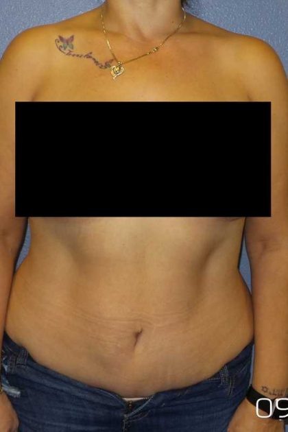 Abdominoplasty Before & After Patient #11131