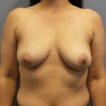 Breast Augmentation Before & After Patient #11334