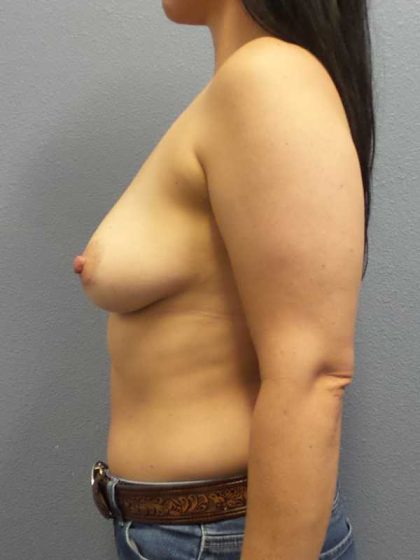 Breast Augmentation Before & After Patient #11334