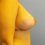 Breast Lift with Implant (Augmentation Mastopexy) Before & After Patient #4482