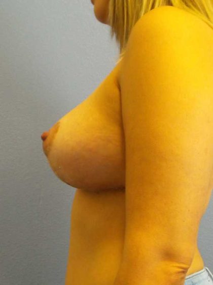 Breast Lift with Implant (Augmentation Mastopexy) Before & After Patient #4482