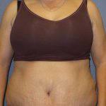 Abdominoplasty Revision Before & After Patient #11142