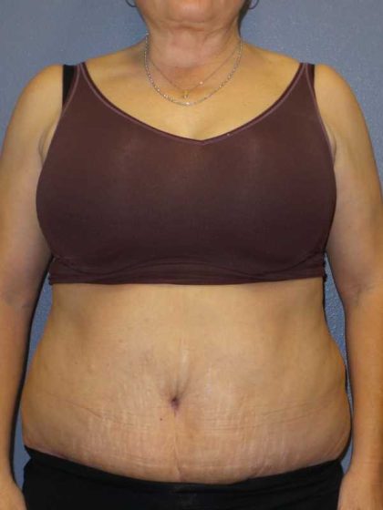 Abdominoplasty Revision Before & After Patient #11142