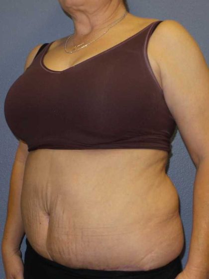 Abdominoplasty Revision Before & After Patient #11142
