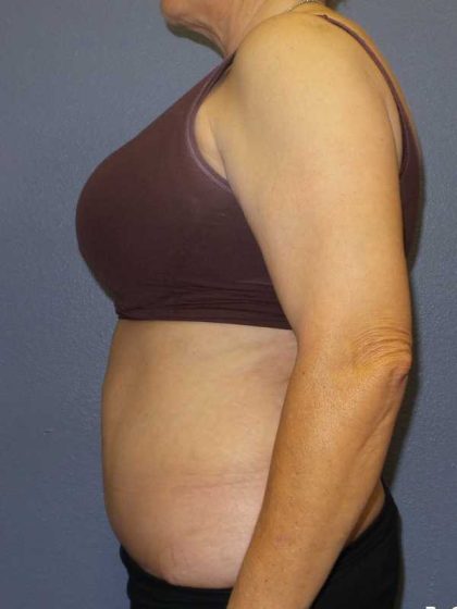Abdominoplasty Revision Before & After Patient #11142