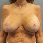 Augmentation Mastopexy Revision Before & After Patient #11269