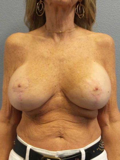 Augmentation Mastopexy Revision Before & After Patient #11269