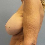 Augmentation Mastopexy Revision Before & After Patient #11269