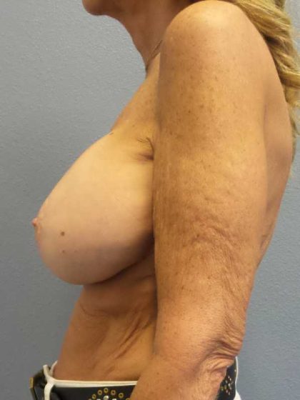 Augmentation Mastopexy Revision Before & After Patient #11269