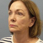 Facelift Before & After Patient #11705