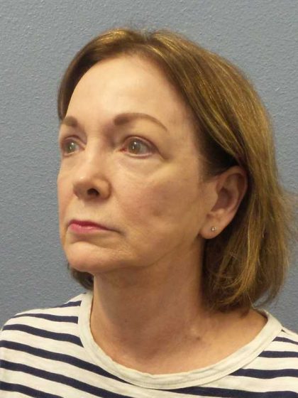 Facelift Before & After Patient #11705