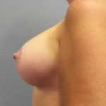 Breast Lift with Implant (Augmentation Mastopexy) Before & After Patient #11178