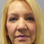 Resurfacing Before & After Patient #12329