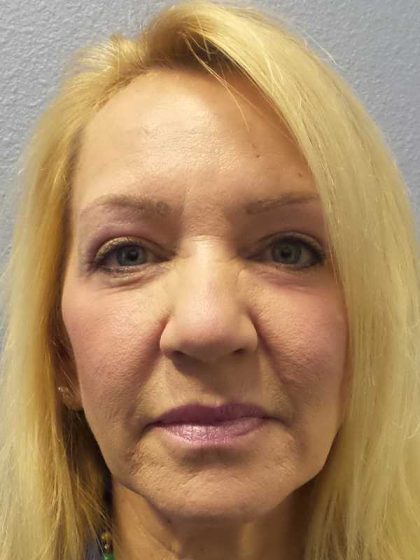 Resurfacing Before & After Patient #12329
