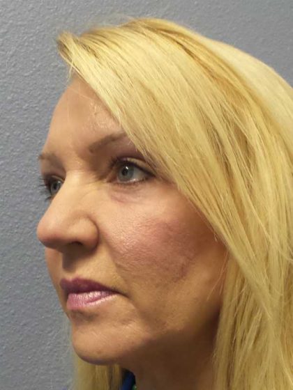 Resurfacing Before & After Patient #12329