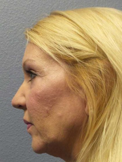 Resurfacing Before & After Patient #12329