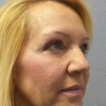 Resurfacing Before & After Patient #12329