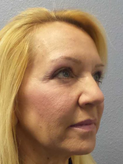 Resurfacing Before & After Patient #12329