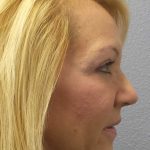 Resurfacing Before & After Patient #12329