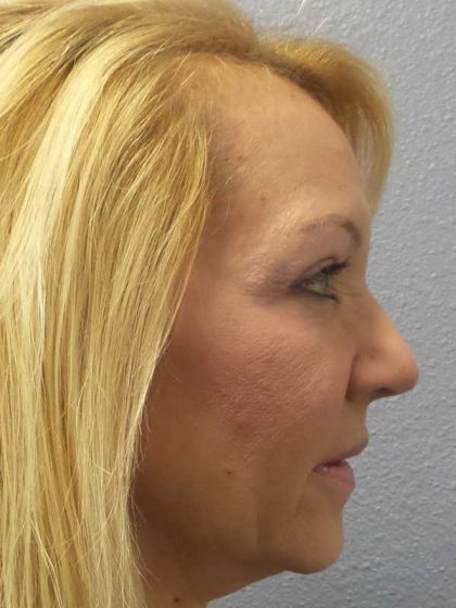 Resurfacing Before & After Patient #12329